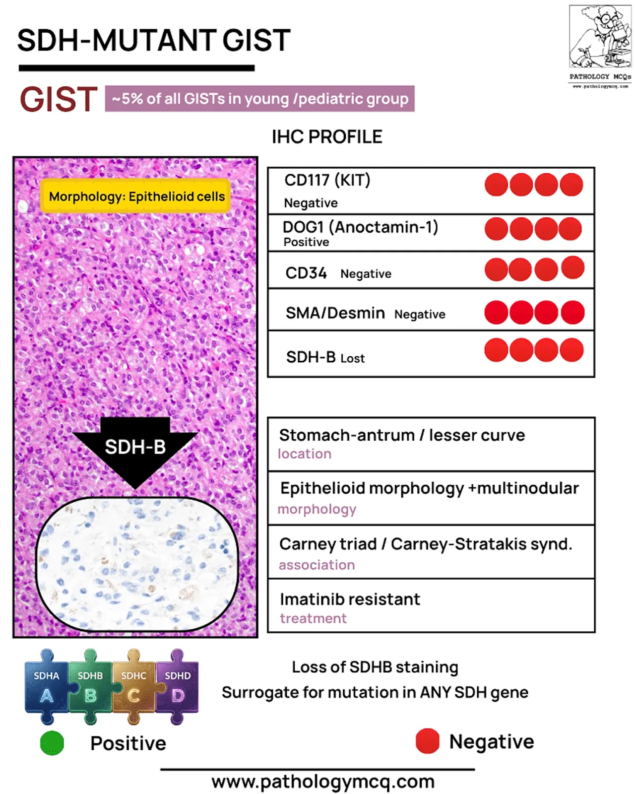 Infographic on SDH-mutant gastrointestinal stromal tumors (GIST), featuring an image of epithelialoid cells and an IHC profile.