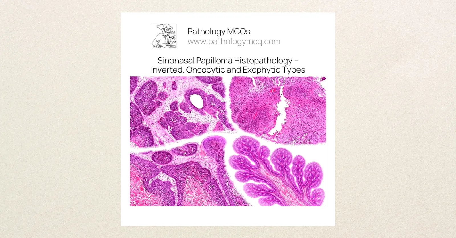 Sinonasal Papilloma Histopathology: Types, HPV Association &amp; Diagnostic Criteria