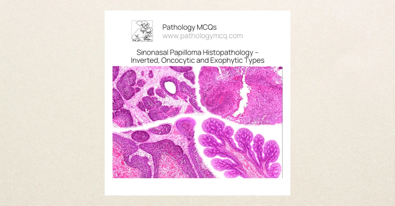 Composite histopathology image showing inverted, oncocytic and exophytic sinonasal papilloma variants