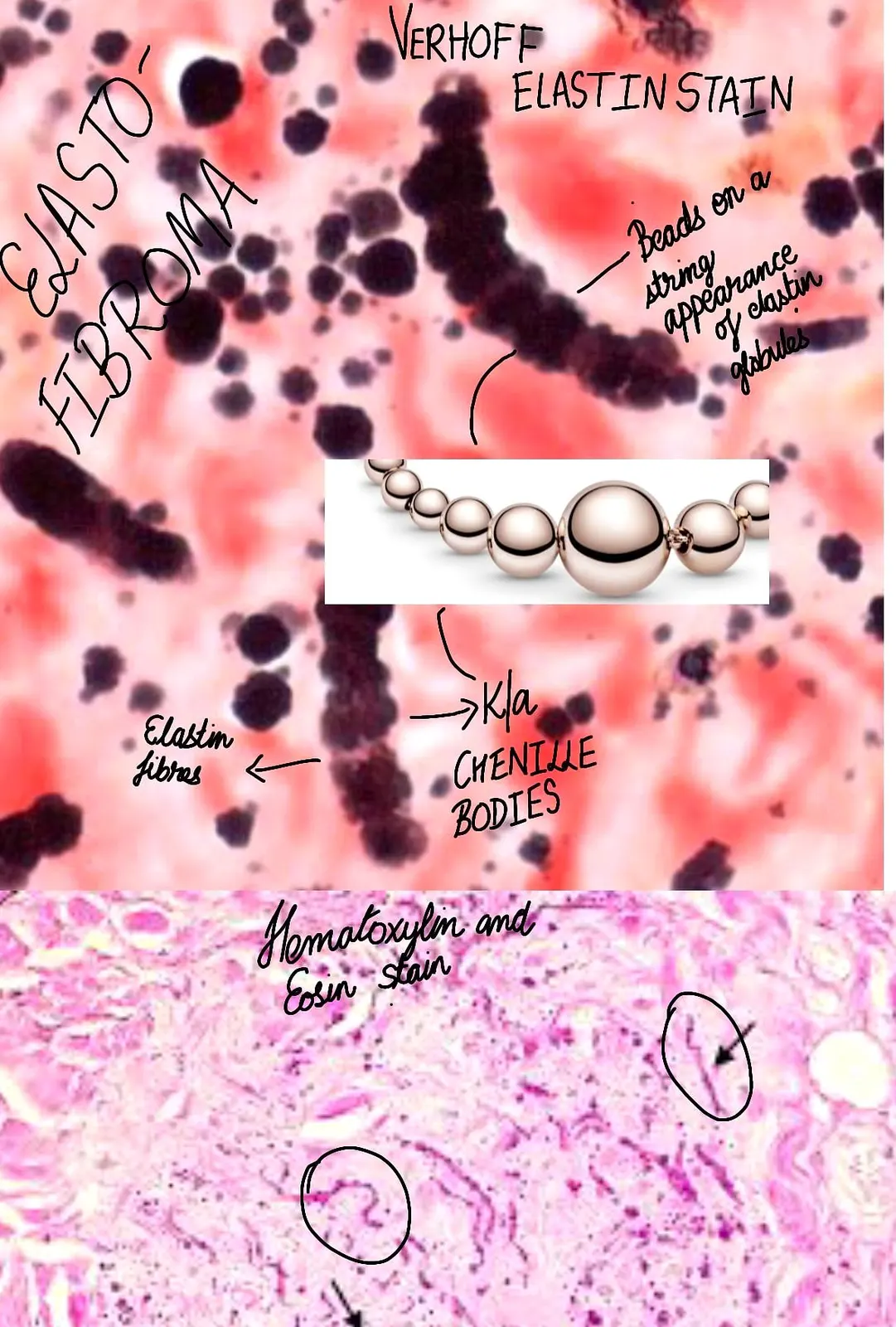 CHENILLE BODIES IN ELASTOFIBROMA