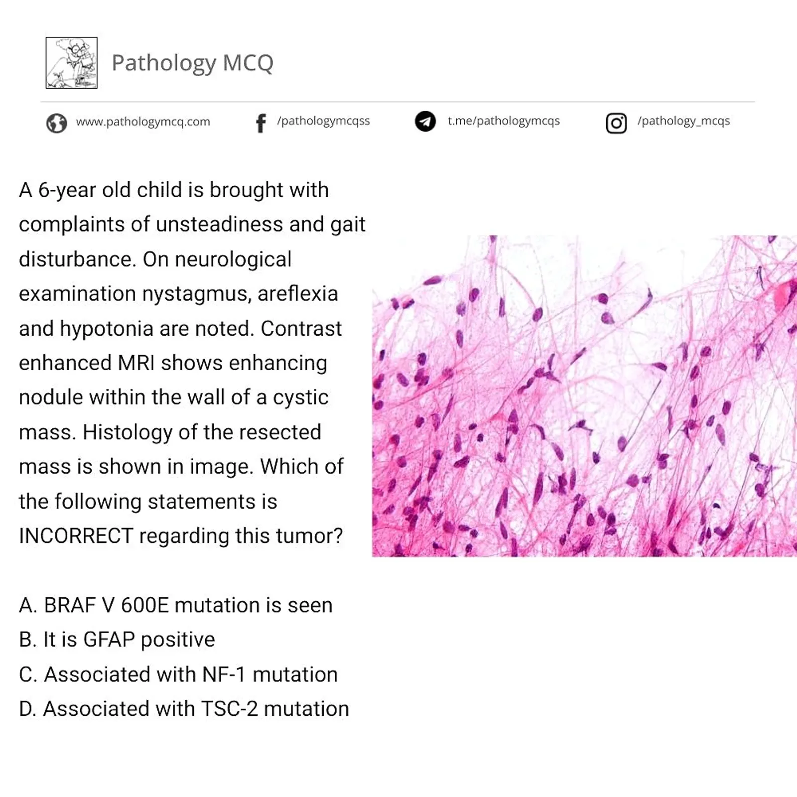 CNS PATHOLOGY MCQ- ASTROCYTOMA
