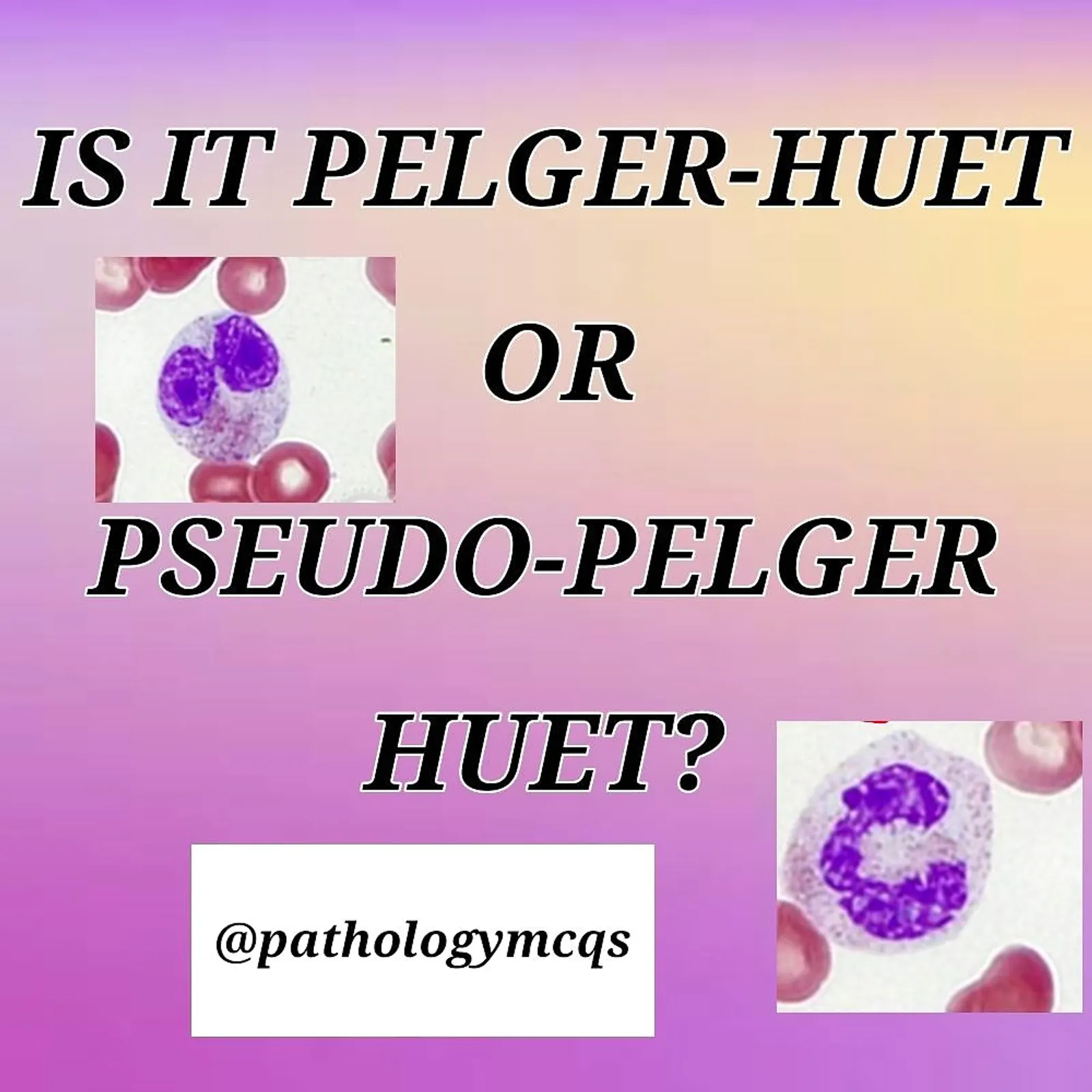 Differentiating congenital pelger-huet anomaly and acquired pseudo-pelger huet anomaly- 5 things to consider.