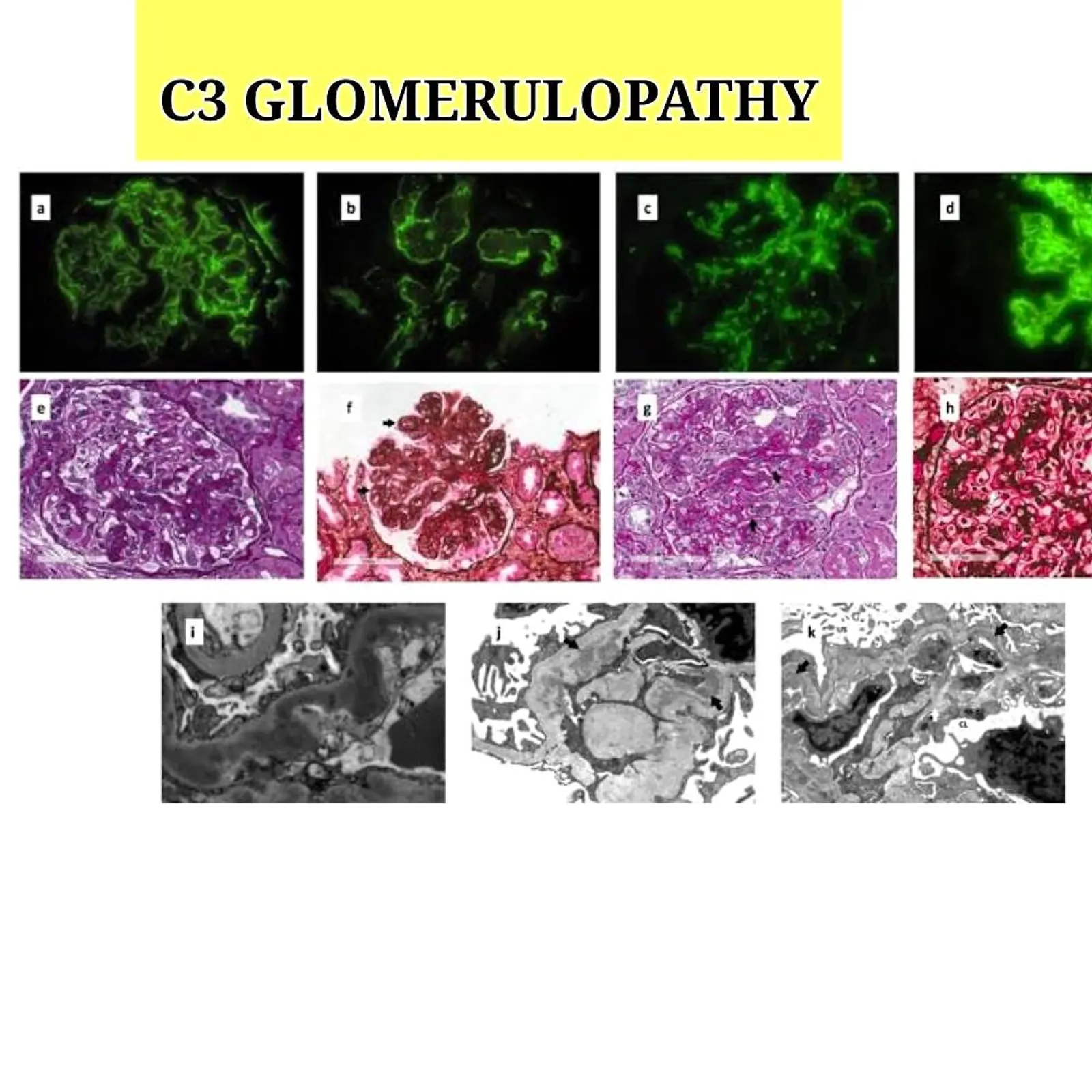 C3 Glomerulopathy- A new entity based on immunofluorescence