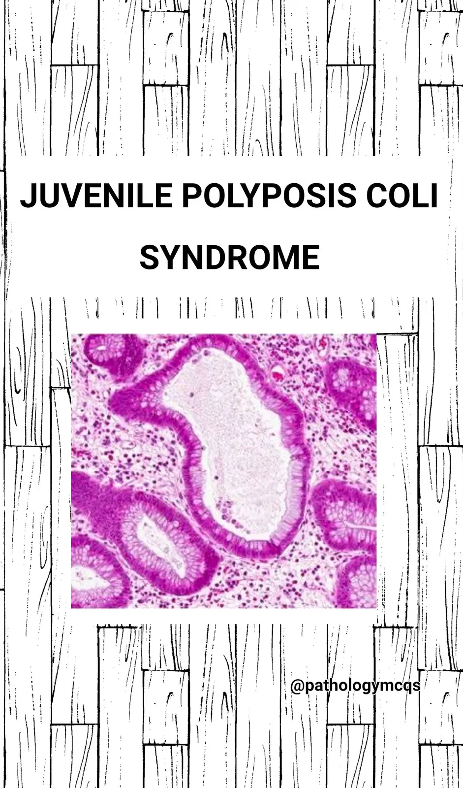 Juvenile POLYPOSIS coli syndrome