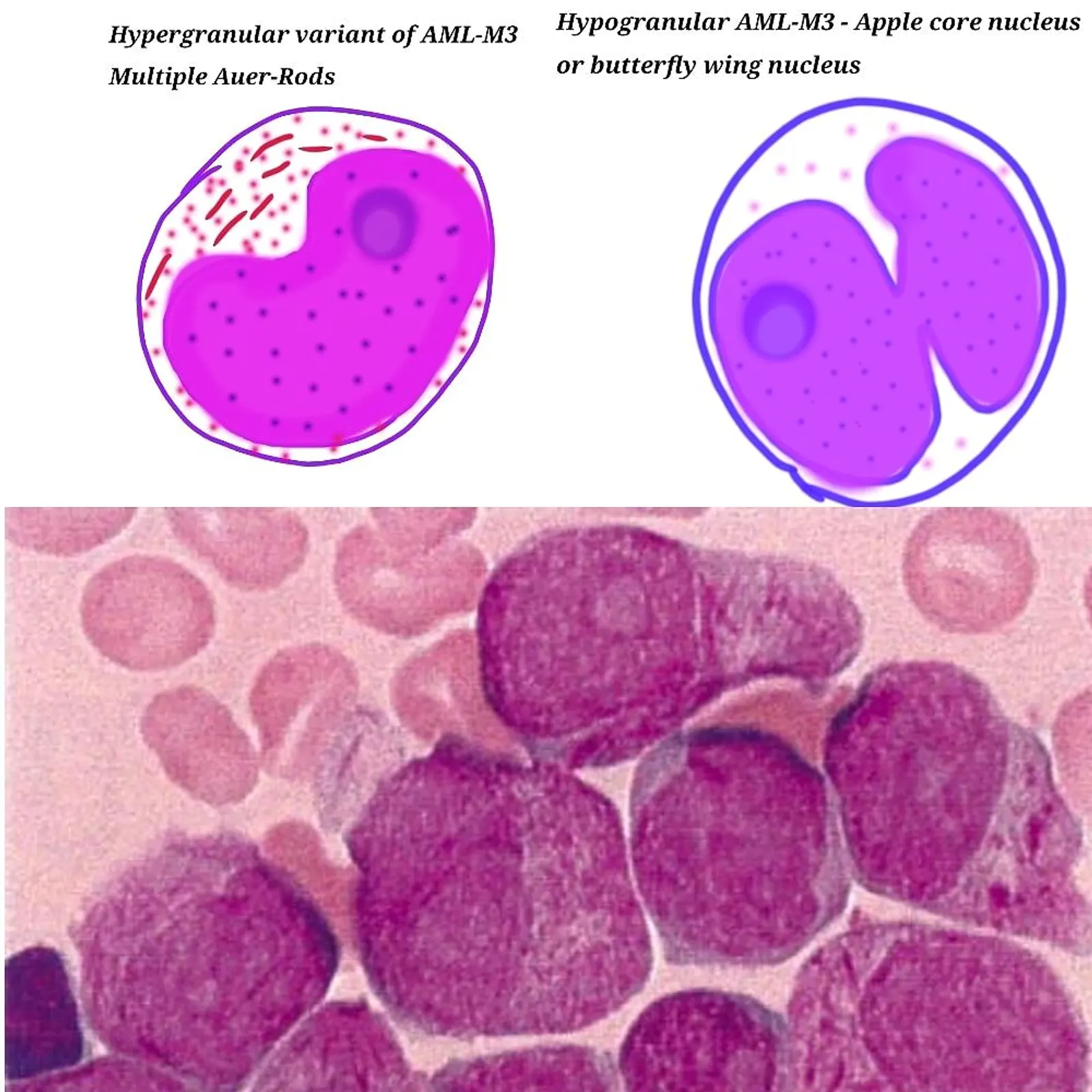 5 Differences between hyper granular (M3) and microgranular (M3v) variants of acute promyelocytic leukemia ( APML)