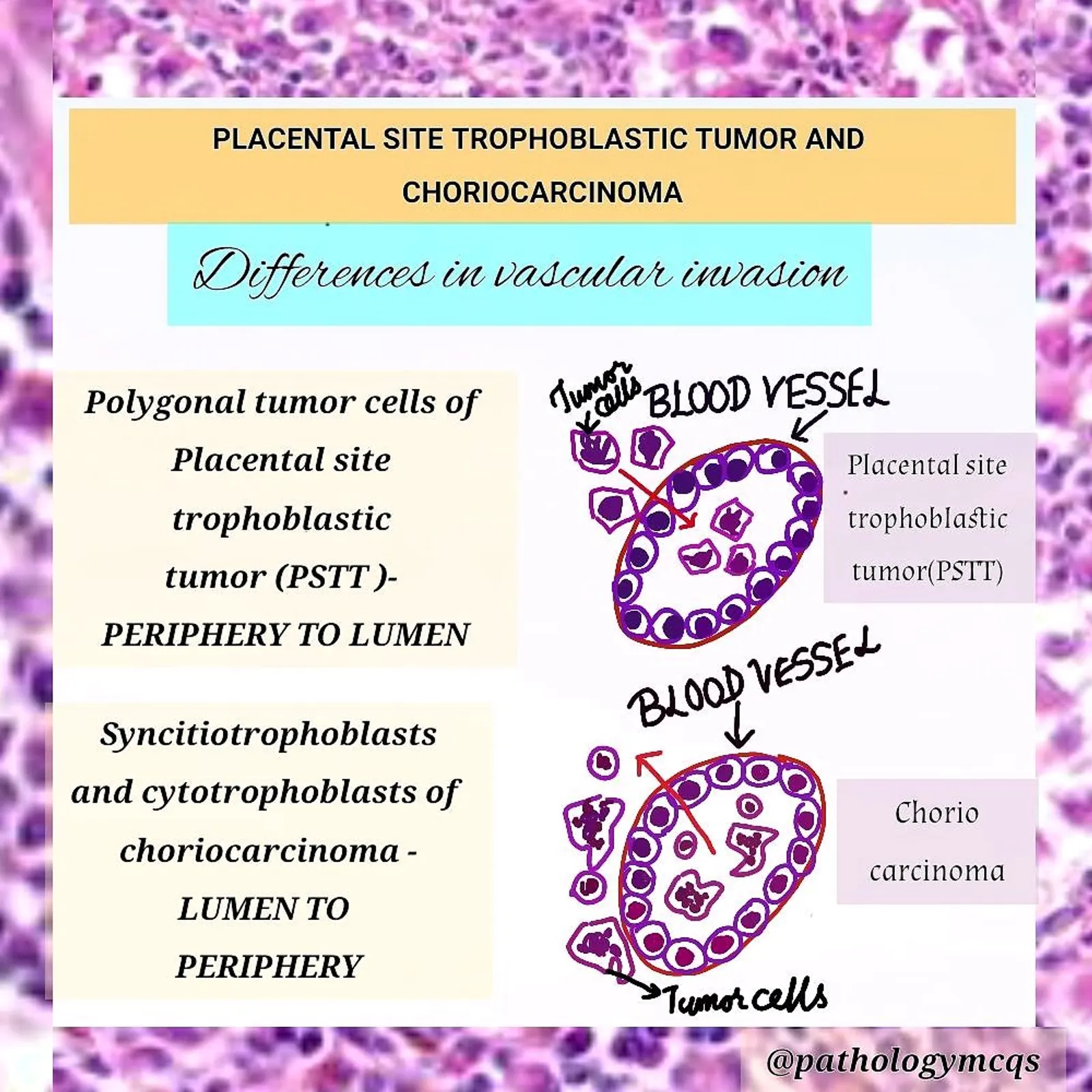 Difference between PSTT ( Placental site trophoblastic tumor) and Choriocarcinoma- Vascular invasion.