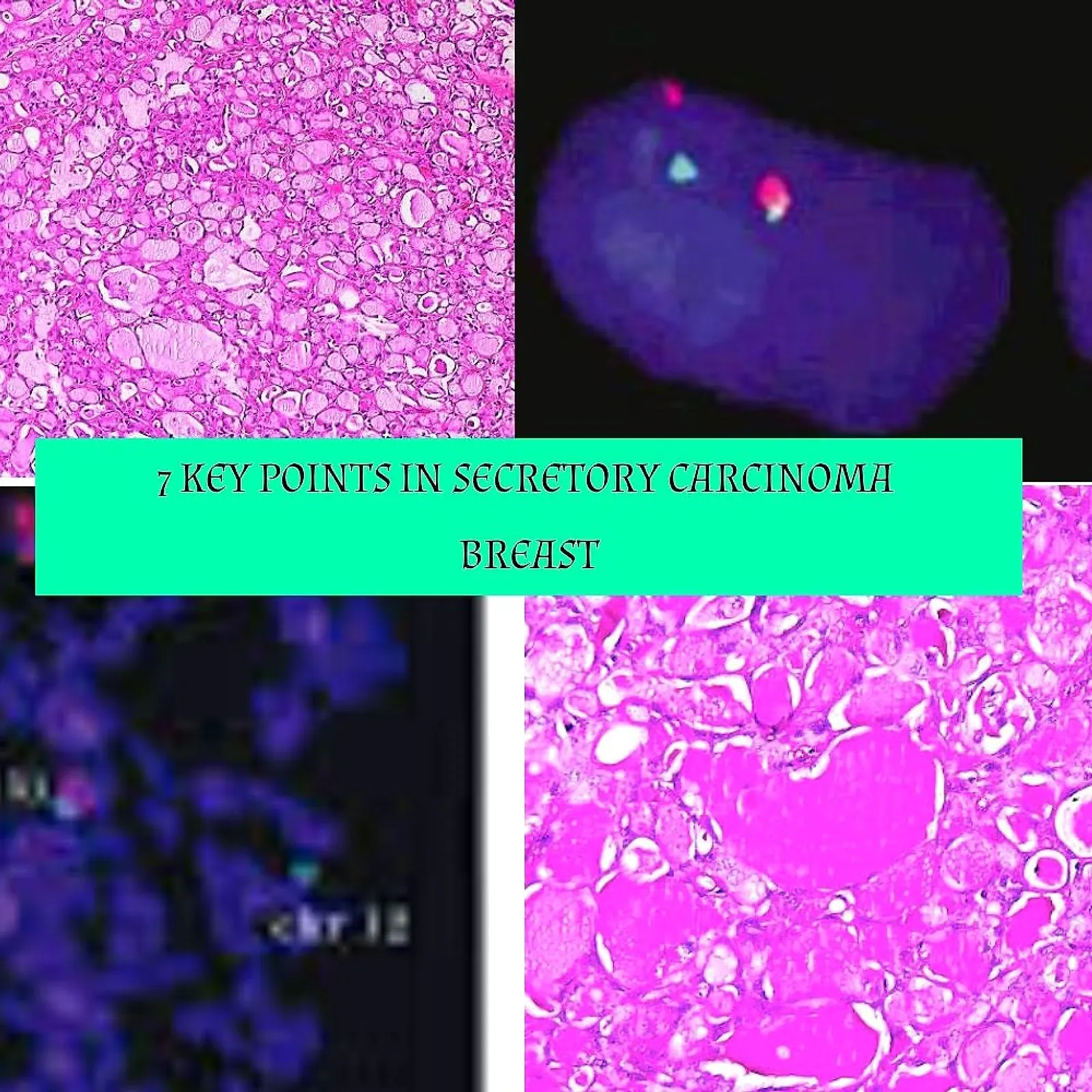 7 Key points- Must know for boards about Secretory carcinoma breast
