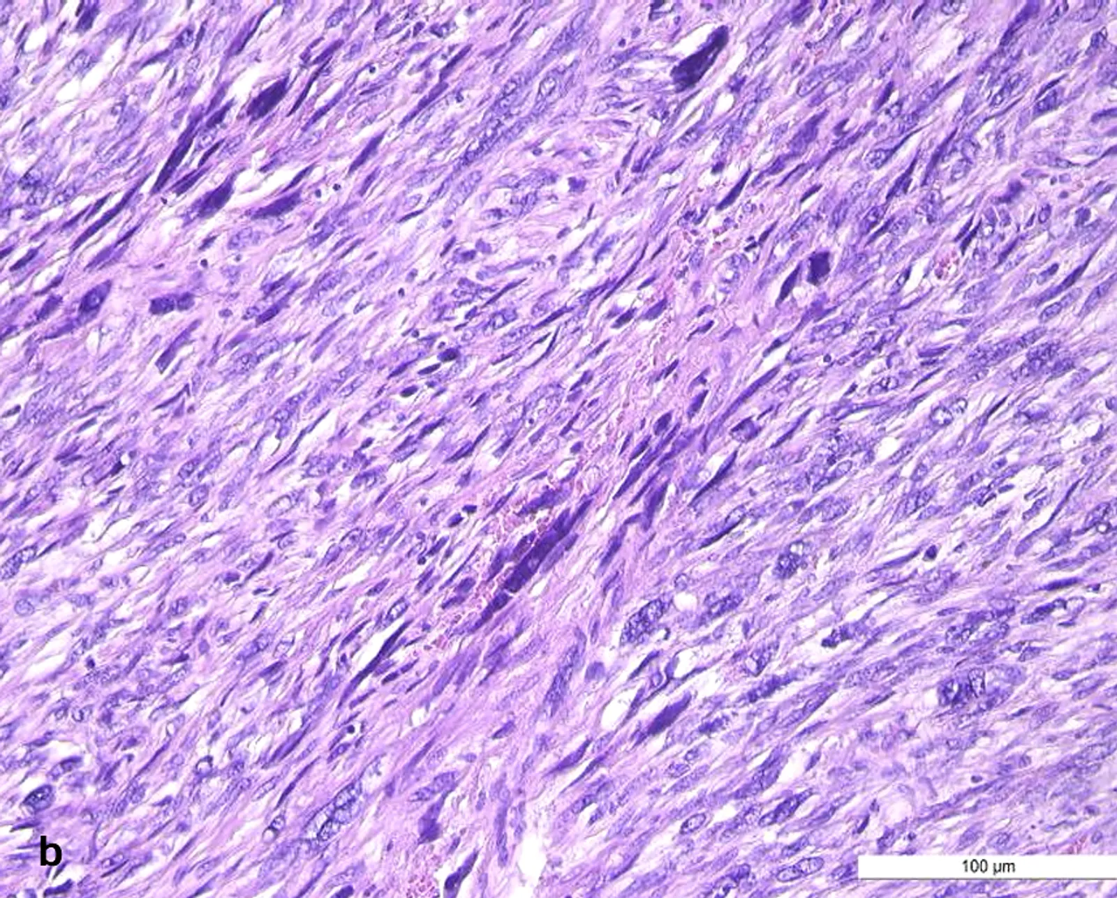 High-power field highlighting pleomorphic hyperchromatic nuclei with atypical mitosis in uterine leiomyosarcoma histopathology.
