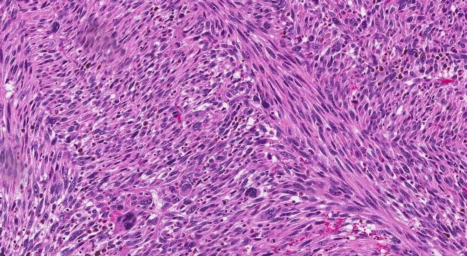 High-power view of spindle cell uterine leiomyosarcoma showing pleomorphic nuclei and brisk mitoses illustrating uterine leiomyosarcoma histopathology.
