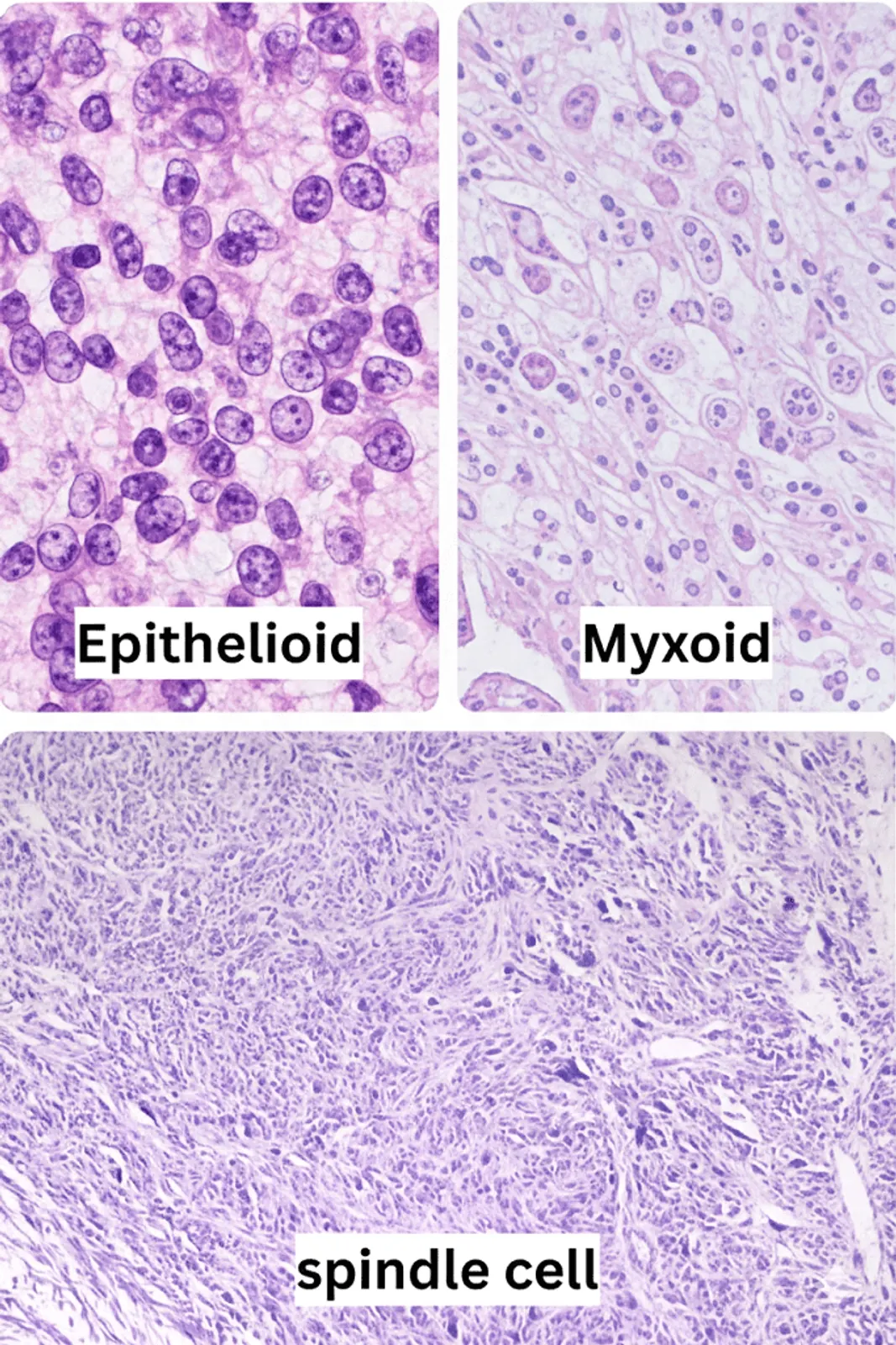 Panel of three micrographs contrasting spindle, epithelioid and myxoid uterine leiomyosarcoma histopathology.
