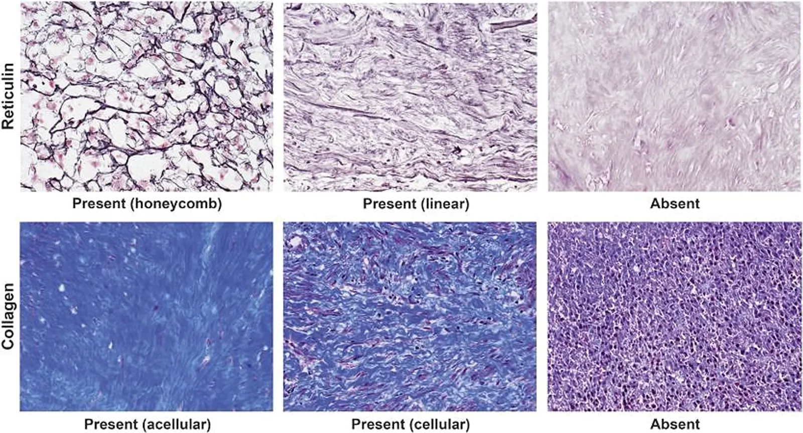 Microscopic field showing abrupt transition from viable tumor to coagulative necrosis in uterine leiomyosarcoma histopathology.