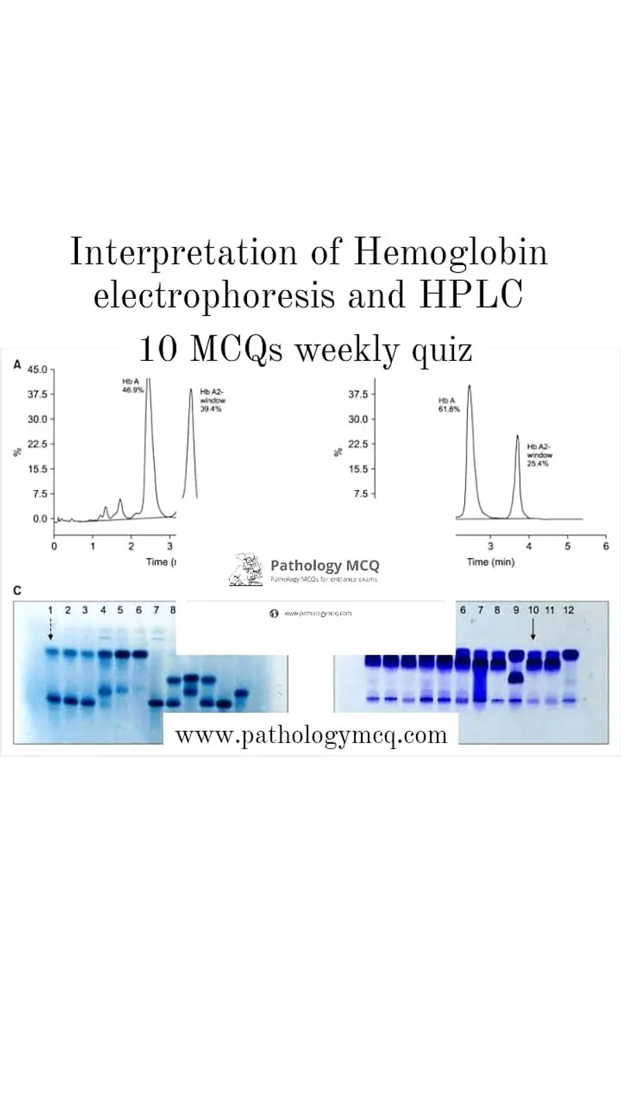 Hemoglobin Electrophoresis and HPLC- Case based quiz